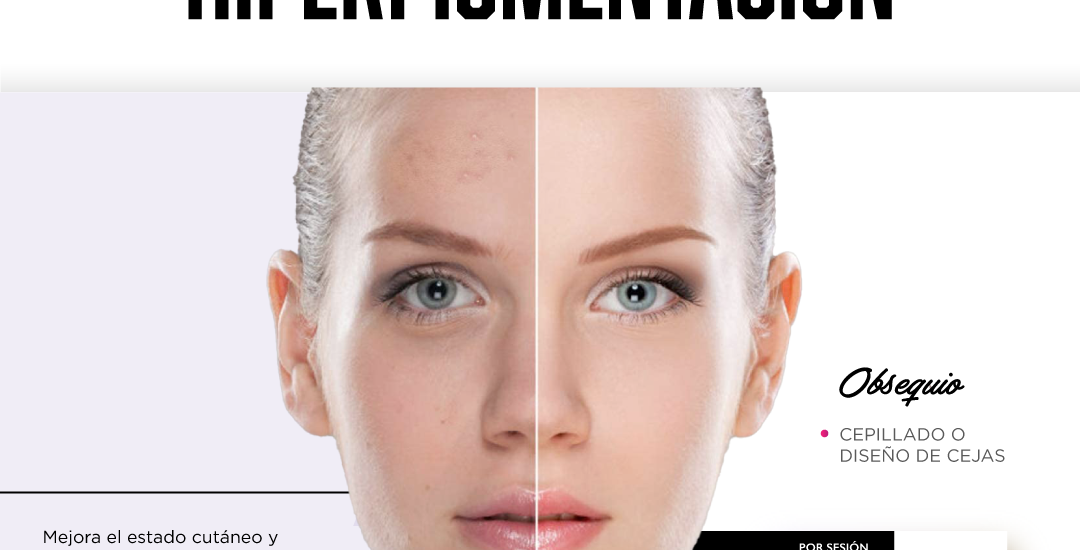 MAGU HIPERPIGMENTACION